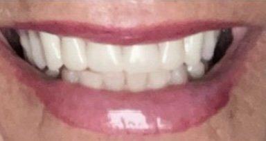 Look at the exact match in color.  I only had the top teeth done.