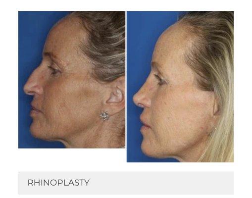 Rhinoplasty surgery 2019