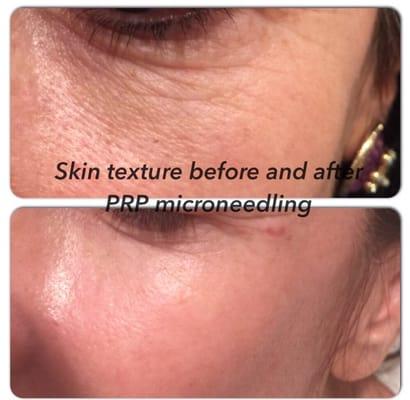 Skin texture is dramatically improved after 4 treatments with PRP injections and microneedling. Amazing!