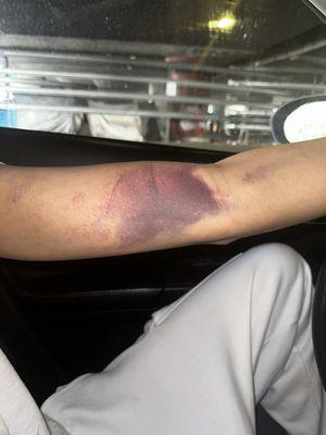 My boyfriends arm after one week of the draw! Smh!