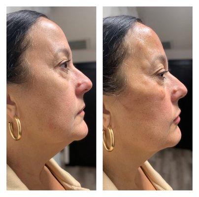 Cheek enhancement that lifts lower face