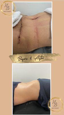 Before & After lymphatic drainage post surgery, text
347 251 1605
ADRESS:
311 85th Street BKLYN NY 11209
Bay Ridge 
Instagram: