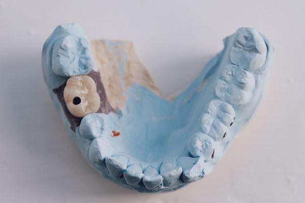 All porcelain implant crown