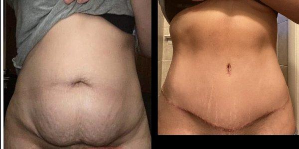 Tummy tuck and Lipo couldn't be more pleased.  I'm 3 months post op and healing and feeling great. Dr. Fugo and his staff are the best.