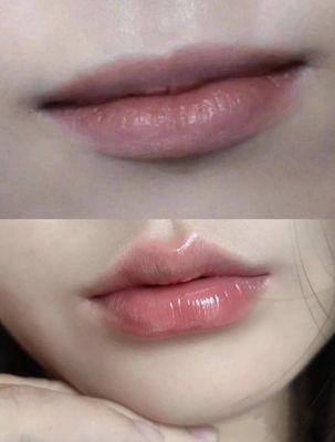 Lip filler