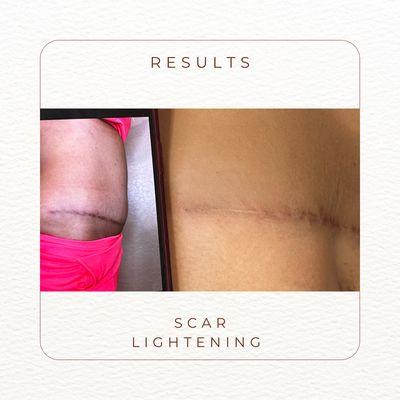 Tummy Tuck Scar lightening