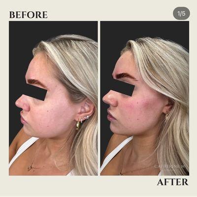 Cheek Filler