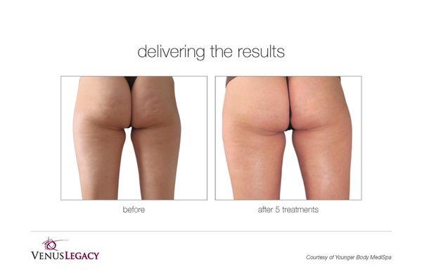 Cellulite reduction and skin tightening