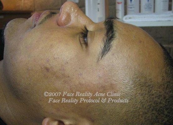 After Treatment from Essentials for Clear Skin - www.essentialsforclearskin.com