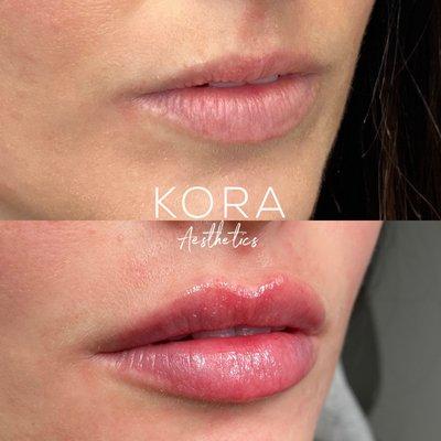 NATURAL lip filler results are possible with the right injector! An example of our signature technique and many years of experience.