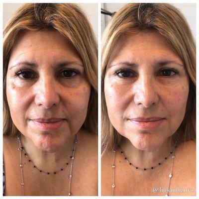 Before and After Fillers