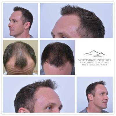 Hair Line - 40 Year Old Male, FUT, 1 Year Results