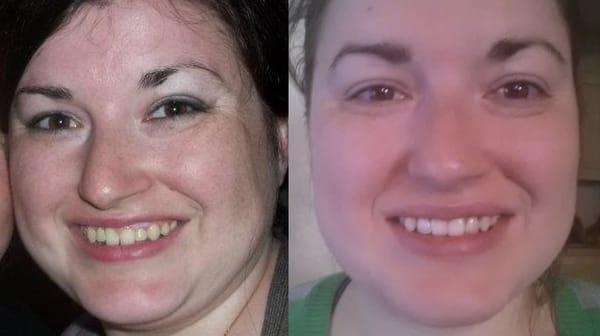 Before (with retainer) and after implants and whitening