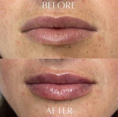 Before and After Lip Filler by Kelly Smith, NP at Avail Aesthetics Cary