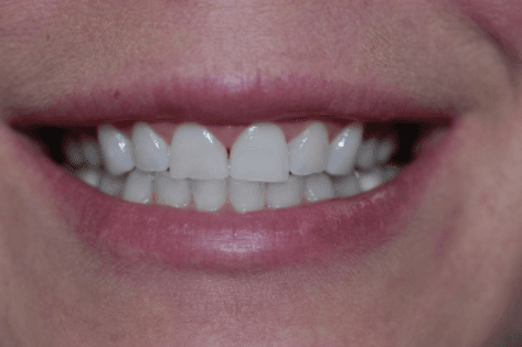 Before First Choice Dental veneers