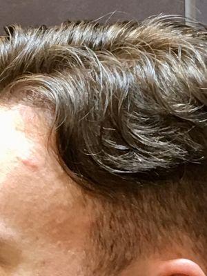 Men's Hair Loss: Treatments and Solutions