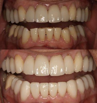 Smile make over - 
Worn crooked lower anteriors redone with ceramic veneers