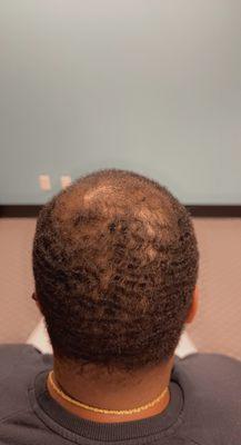 Male Client Hair Restoration Consult