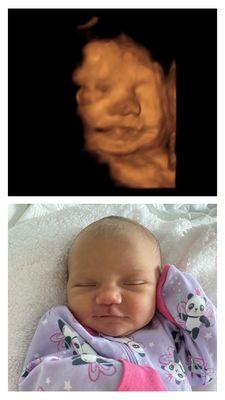 31 weeks 3D before and after birth