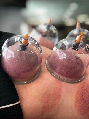 Cupping therapy for pain relief