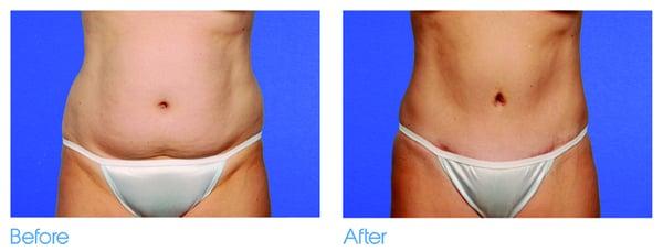 Liposuction - Before & After.