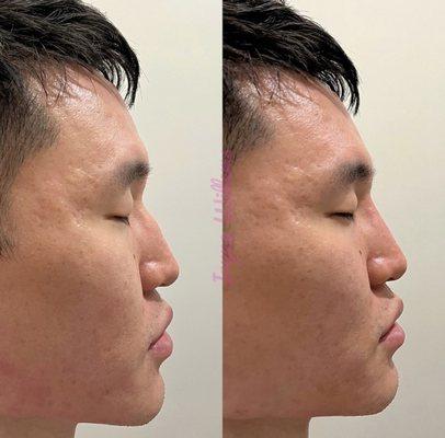 Non-surgical Rhinoplasty
 @rejuvenationbyirina