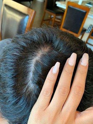 Before scalp micropigmentation density on crown