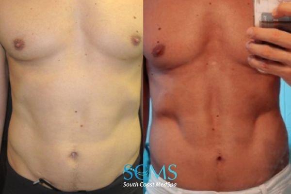 Morpheus8 Before and After 3 Treatments,  showing amazing reduction in stubborn fat