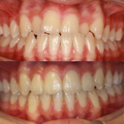 15 month Invisalign treatment !