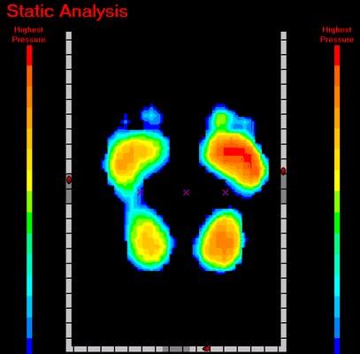 Digital 3-D pressure scan used to make custom orthotics