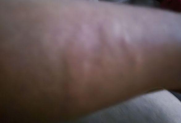 Welts and rashes on left arm.