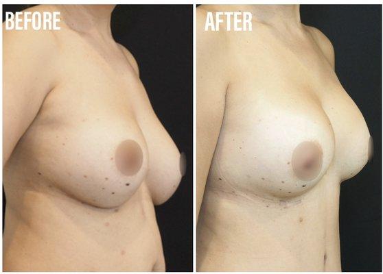 Breast Augmentation Revision