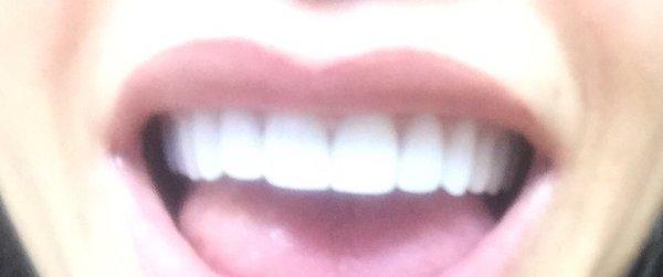 Thank you, Dr Athari for my beautiful teeth!