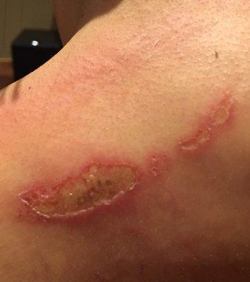 I received a first and second degree burn from David Dong. Worst part is that he denied causing this damage. Very dishonest person!