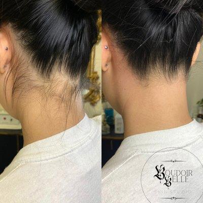 Nape of Neck Sugaring