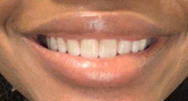 My sparkly clean teeth!