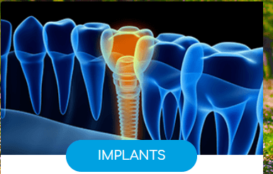 Implants for You!