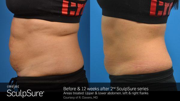 Permanent fat melting with Sculpsure