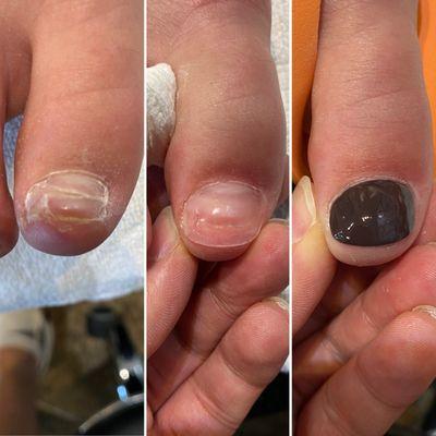 Toenail reconstruction, no acrylics