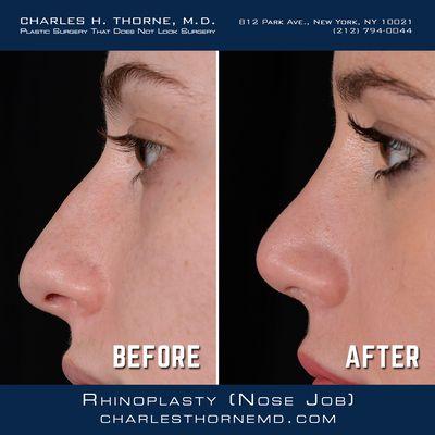 Rhinoplasty (Nose Job) Before & After Images