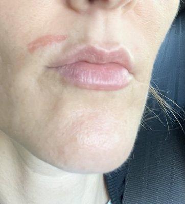 Third-degree burn on my lip after being wax by Kim at Today Nails !