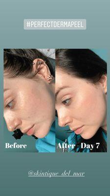 Perfect Derma Peel RX before/after