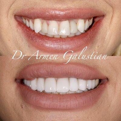 Smile makeover with 10 porcelain veneers