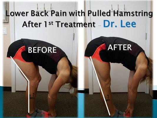 Lower Back Pain with right pulled hamstring after 1st soft tissue treatment - Dr. Lee