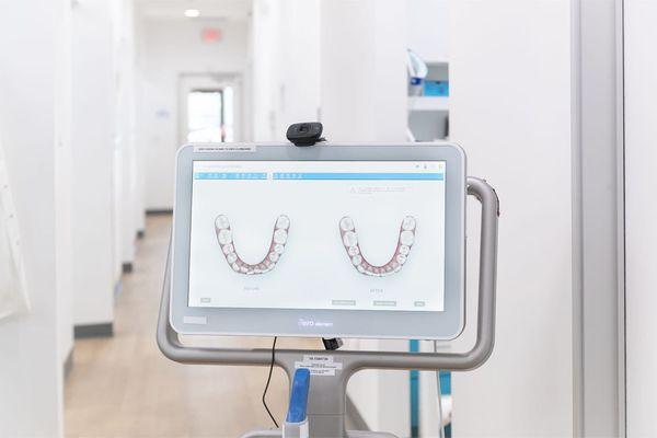 Digital scanners for 3d model of teeth. No more goopy impression material for invisalign and crowns.