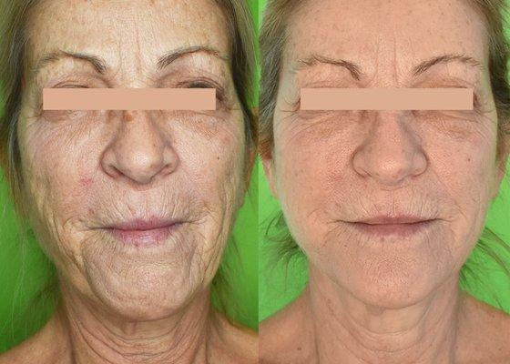 Plasma skin tightening and resurfacing.