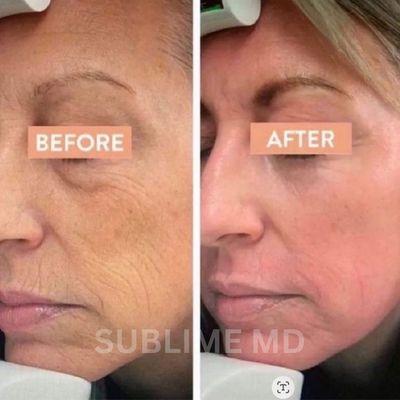 Results after 1 CO2 Laser Resurfacing treatment.