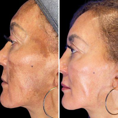 Before and After Melasma transformation.