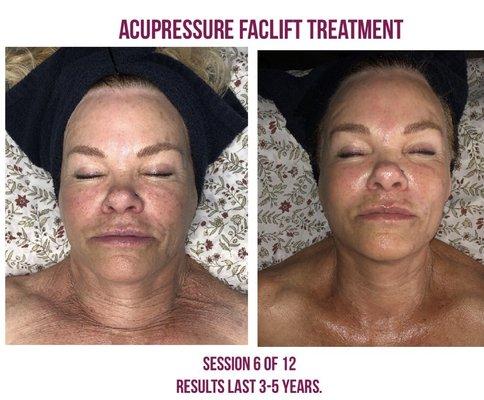 Acupressure Face-Lift Treatment Series.