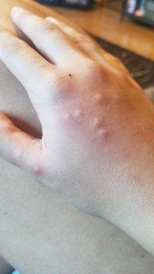 Bed bug bites